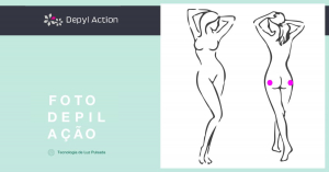 Depilação Feminina da Lateral Anal com Luz Pulsada Depyl Action