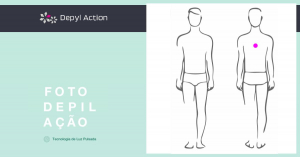 Depilação Masculina da Região Dorsal com Luz Pulsada Depyl Action